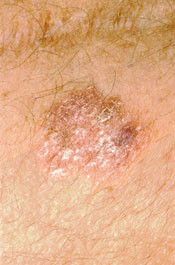 Figur 7  Morbus Bowen