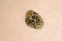 Figur 12  Seborroisk v&aring;rta