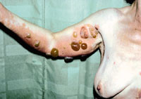 Figur 18  Bull&ouml;s pemfigoid