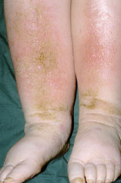 Figur 21  Epiteliomat&ouml;s hyperplasi