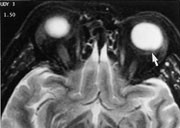 Figur 2  Malignt melanom gir lavt signal p&aring; T2-vektet MR-bilde (pil)