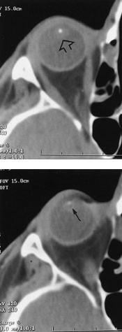 Figur 6  57 &aring;r gammel mann med intraokul&aelig;rt fremmedlegeme av glass (pil). Glass gir i motsetning til metall ikke artefakter&hellip;