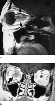 Figur 6  a) 54 &aring;r gammel kvinne med h&oslash;yresidig optikusmeningeom. Nerven har lavere intensitet enn tumor i det parasagittale&hellip;