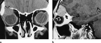 Figur 8  a) 35 &aring;r gammel mann med lymfom. CT viser beindestruksjon i koronale snitt (pil).  b) MR viser tumoravgrensningen&hellip;