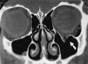 Figur 10  Ung gutt med dobbeltsyn etter slag mot venstre &oslash;ye. CT viser &rdquo;blow-out-fraktur&rdquo; (pil)