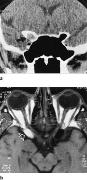 Figur 11  a) 55 &aring;r gammel mann med lateralt etmoidalt mukocele. CT viser asymmetri med luftfylt cellesystem p&aring; venstre og&hellip;