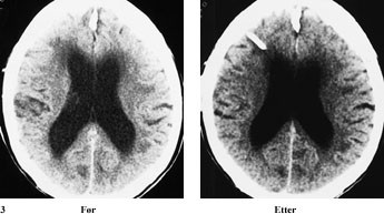 Figur 3   Postoperativ bedring ved testing kan ofte sees p&aring; tross av at ventrikkelst&oslash;rrelsen er tiln&aelig;rmet uendret. CT-bilder&hellip;