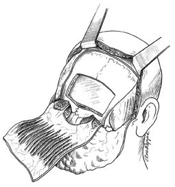 Figur 2   Bifrontal kraniotomi for tilgang til mediale del av fremre skallegrop og fripreparert frontogaleal periostlapp for&hellip;