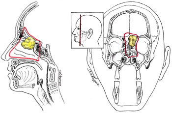 Figur 3   Omfanget av en reseksjon hvor man medtar hele etmoidalregionen p&aring; en side og deler av etmoidalregionen p&aring; motsatt&hellip;
