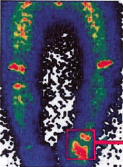 Figur 3   Skjelettscintigrafi av begge underekstremiteter, vaskul&aelig;r fase, posterior projeksjon, viser patologisk &oslash;kt&hellip;