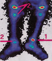 Figur 4   Skjelettscintigrafi, posterior projeksjon, viser patologisk hyperaktivitet proksimalt for h&oslash;yre ankel (1). Markert&hellip;