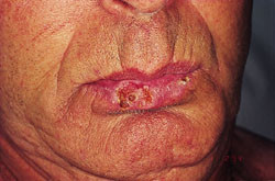 Figur 2   Plateepitelkarsinom p&aring; leppe