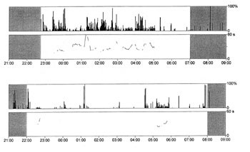 Figur 2   Aktigrafisk registrering av beinbevegelser f&oslash;r behandling (&oslash;verst) og under behandling (nederst) med klonazepam 2&hellip;