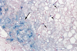Figur 2   Histologisk snitt av leverbiopsi fra pasient 1. Ved Perls&rsquo; fargemetode ble det p&aring;vist patologisk jernavleiring i&hellip;