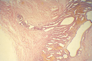 Figur 3   Endometriosv&auml;vnad kan v&auml;xa in i omgivningen ( &sdot; 200).