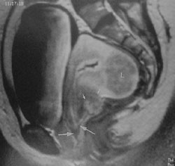 Figur 4   Endometrios kan eventuellt lokaliseras med MR om h&auml;rden inneh&aring;ller gammalt blodpigment och &auml;r tillr&auml;ckligt stor. &hellip;