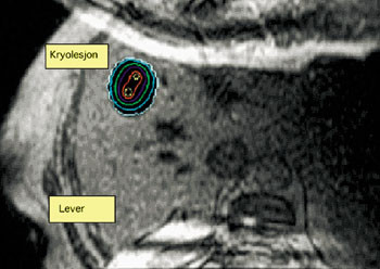 Figur 4   MR-bilde av en kryolesjon hos en pasient med kolorektal metastase. Et temperaturkart som angir MR-estimert&hellip;