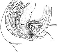 Figur 3   Anatomisk oversikt med vaginalprotesen p&aring; plass og suprapubisk urindrenasje