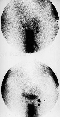 Figur 4   Pasient med T1 (< 2 cm) plateepitelcancer i venstre labium major med to vaktpostlymfekjertler langs venstre vena&hellip;