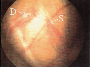 Figur 2   Laparoskopisk bilde av h&oslash;yre side viser at ductus deferens ender blindt (D), og at v. og a. spermatica ender&hellip;