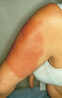 Figur 2   Klassisk erysipelas hos 40 &aring;r gammel kvinne etter vaksinasjon. Merk h&oslash;yr&oslash;dt utslett med skarp avgrensning mot&hellip;