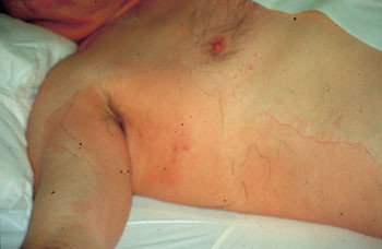 Figur 3   Nekrotiserende fasciitt hos 65 &aring;r gammel mann. Prim&aelig;rfokus var et lite s&aring;r p&aring; h&oslash;yre h&aring;nd. Merk blast r&oslash;dfarget&hellip;