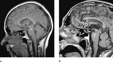 Figur 4   a) En normal sella turcica med en normal hypofyse (a) og hypofysestilk (b). b) Prim&aelig;rt tom sella-syndrom&hellip;