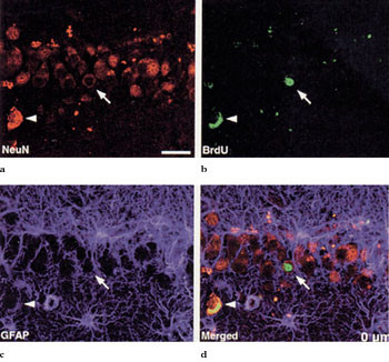 Figur 3   Demonstrasjon av prolifererende nevrale stamceller i et snitt fra menneskehjernens hippocampus (9).  a) Kornceller&hellip;