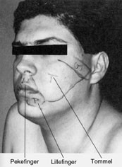 Figur 4   Kortikal reorganisering etter amputasjon av en arm hos menneske (25). Bildet viser de omr&aring;dene p&aring; pasientens&hellip;