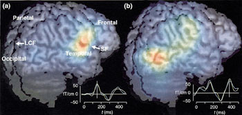 Figur 5   Aktivering av synsbarken under en auditiv oppgave hos blinde (29). Fargene p&aring; hjerneoverflaten viser aktivitet&hellip;