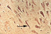 Figur 2   HE/s&oslash;lvfarget snitt fra pasient med Alzheimers sykdom. Nevrofibrill&aelig;re tangler (pil)