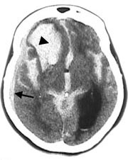 Figur 3   Cerebral CT viser stort hematom i h&oslash;yre frontallapp (pilspiss) og rikelig blod i subaraknoidalrommet i basale&hellip;