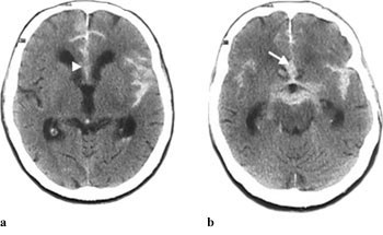 Figur 4   Cerebral CT viser  a) blod i septum pellucidum (pilspiss) hos pasient med b) aneurisme (pil) p&aring; a. communicans&hellip;