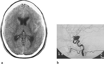 Figur 5   a) Cerebral CT fire timer etter debut av kraftig bakhodepine viste sparsom mengde blod i fissura Sylvii,&hellip;