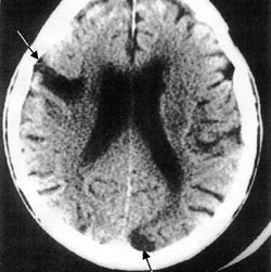 Figur 2   Cerebral CT hvor det p&aring;vises to (piler) gjennomg&aring;tte tromboemboliske infarkter