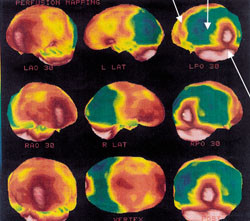Figur 3   Cerebral SPECT av en pasient med Alzheimers sykdom med sterkt redusert blodgjennomstr&oslash;mning temporoparietalt p&aring;&hellip;