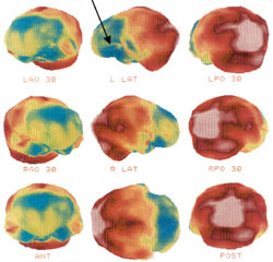 Figur 4   Cerebral SPECT av en pasient med frontotemporallappsdemens. For forklaring se figur 3. Blodgjennomstr&oslash;mningen er&hellip;