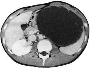 Figur 2   CT-bilde av pasient 2 viser milt med cyste med st&oslash;rste diameter 16 cm