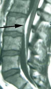Figur 5   Lumbosakral MR av et filum terminale-lipom (pil)
