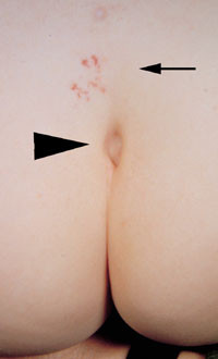 Figur 7   Dorsalt dermalsinus hvor en epitelkledd kanal forbinder huden med dypereliggende strukturer (pilhode)&hellip;