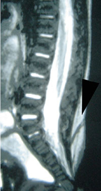 Figur 8   Lumbosakral MR av et dorsalt dermalsinus (pilhode)
