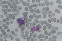 Figur 3   Pasient 2. Erytrocytter infisert med opptil 4 &ndash; 5 P falciparum-trofozoitter, parasittemi p&aring; 40 &ndash; 50 %