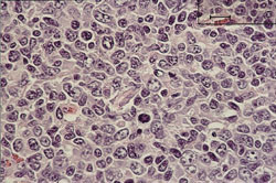 Figur 2   H&oslash;ygradig non-Hodgkins lymfom i halslymfeknute. Blastceller