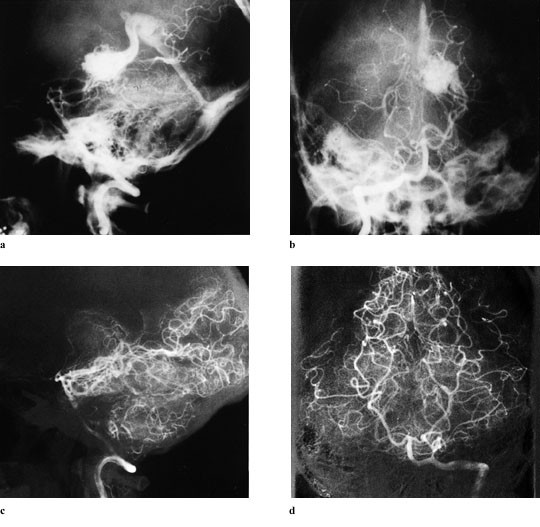 Figur 2   Total obliterasjon av en 4 cm&sup3; stor arterioven&oslash;s malformasjon ved lamina quadrigeminalis. a, b) &Oslash;verst: Side- og&hellip;