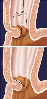Figur 4   Knytting av plikat: Endene p&aring; tr&aring;den, som n&aring; er festet i to slimhinnefolder (&oslash;verst), kan knyttes manuelt, hvor en&hellip;