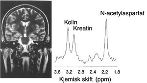 Figur&thinsp;&thinsp;2  Normalt spekter fra hjernevev (utvalgt volum vist i MR-bildet til venstre). Forholdet mellom N-acetylaspartat og&hellip;