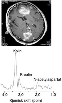 Figur&thinsp;&thinsp;3 Spekter fra en malign hjernesvulst. Opptaket er gjort med en s&aring;kalt PRESS-sekvens med ekkotid lik 135 ms. B&aring;de N&hellip;