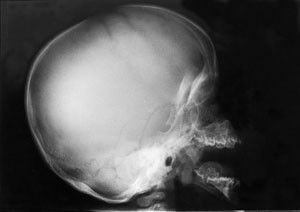 Figur&thinsp;&thinsp;2 R&oslash;ntgen av kraniet viser et forst&oslash;rret nevrokranium