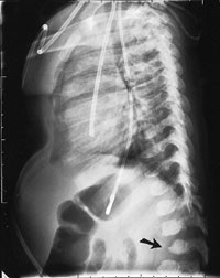 Figur&thinsp;&thinsp;3 R&oslash;ntgen av columna viser kyfose i den torakolumbale overgangen. Legg merke til virvelcorpus L1 som er formet&hellip;
