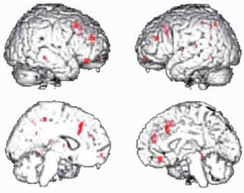 Figur 3  Effekt av COMT-genotype p&aring; funksjonell magnettomograf (fMR)-aktivering, under en hukommelsestest m&aring;lt med BOLD EPI&hellip;